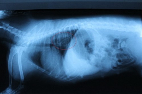 Рис 1.Рентгенограмма. Инородное тело в дистальной части грудного отдела пищевода.