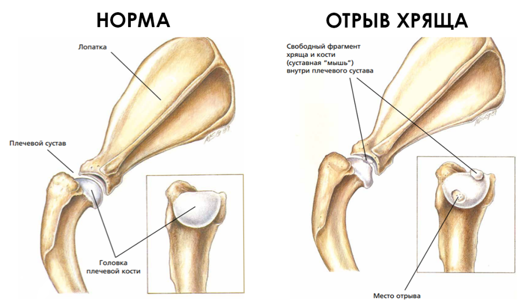 Плечевой сустав с разрывом