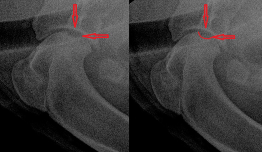 Ямка по месту отслоения хряща 1-1
