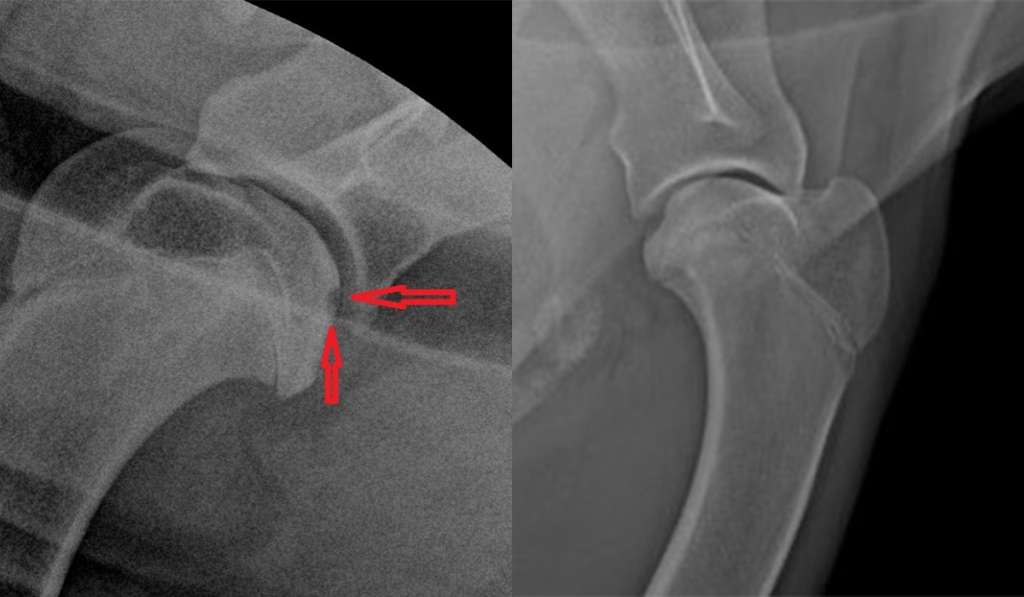 Ямка по месту отслоения хряща 2-2