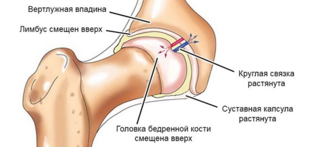 Болезнь Пертеса-1