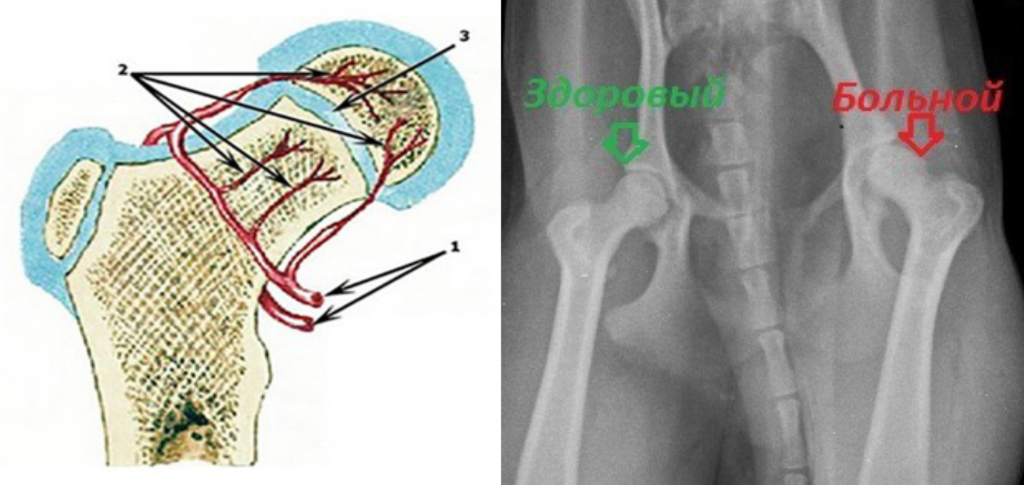 Болезнь Пертеса-2
