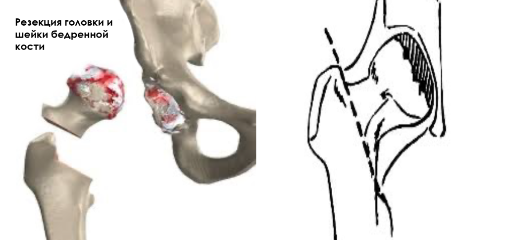 Болезнь Пертеса-9