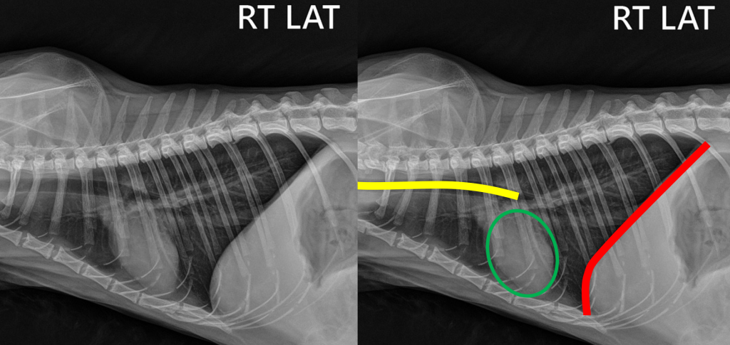 Гидроторакс -1