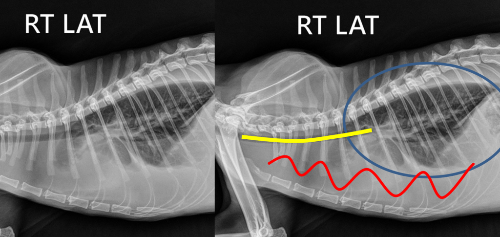 Гидроторакс -2