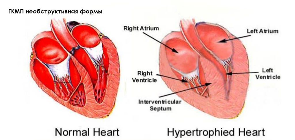 Гипертрофическая кардиомиопатия - 1