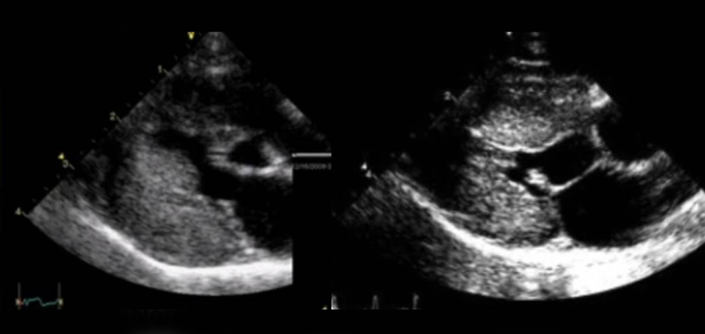 Гипертрофическая кардиомиопатия - 2