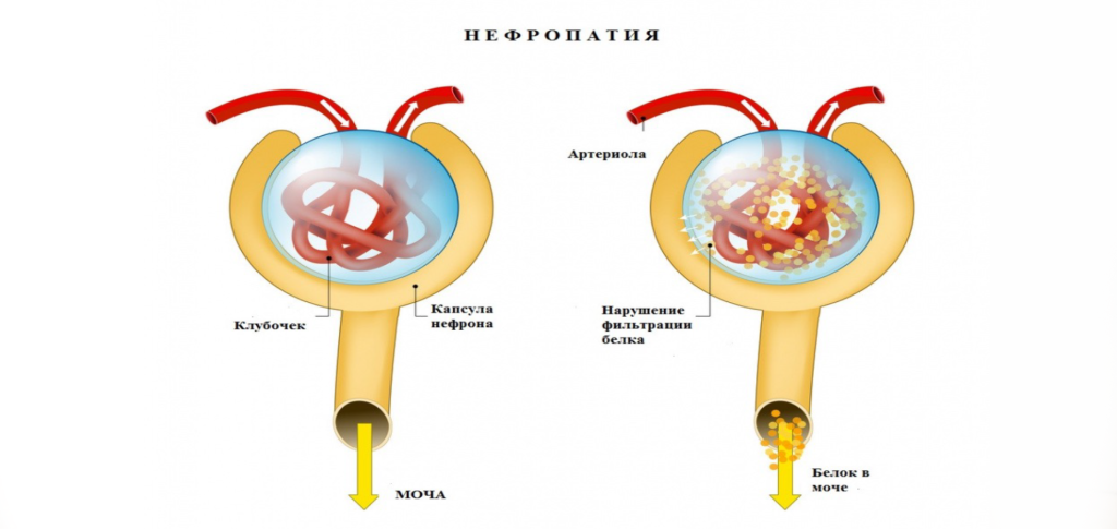 Нефропатия-1