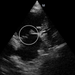 эндокардиоз-1