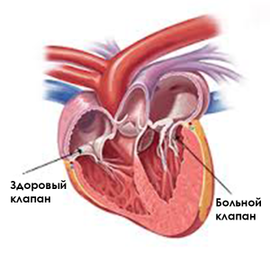эндокардиоз-2