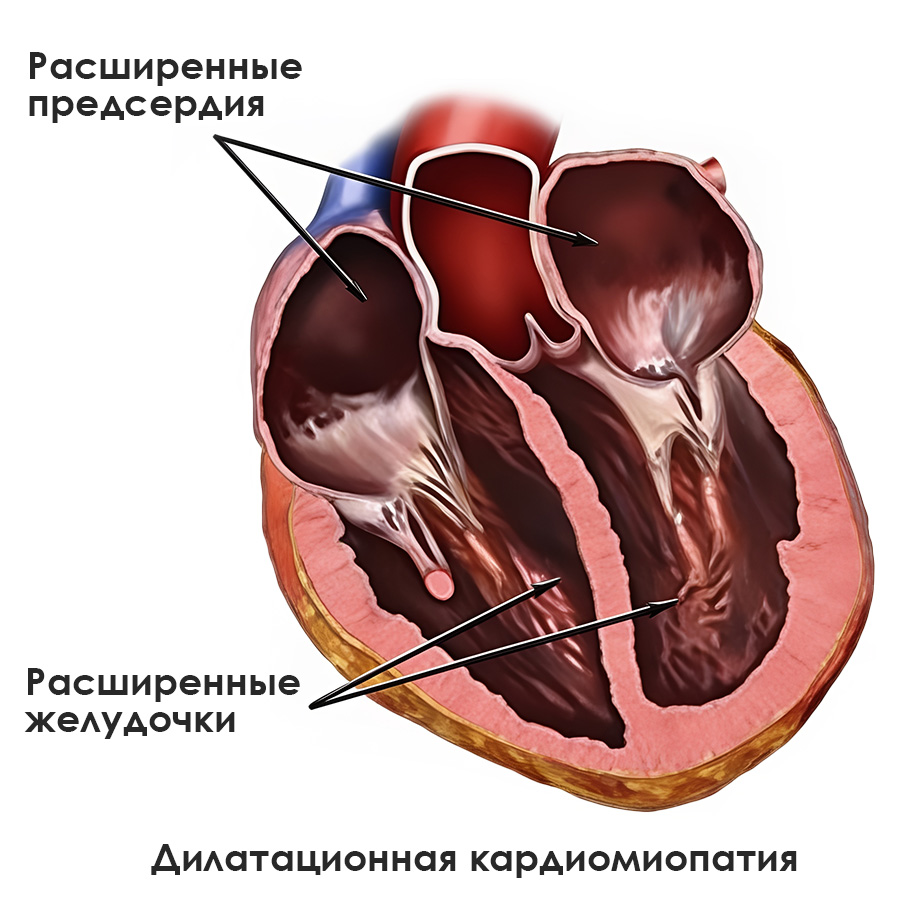 кардиомиопатия у котов - 1-1