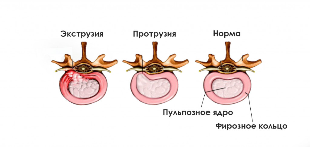 Болезни межпозвоночных дисков-1