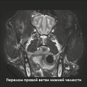 ЧМТ - 1